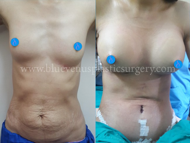 Best & Safe Tummy Tuck Surgery At Blue Venus Plastic Surgery In Raipur